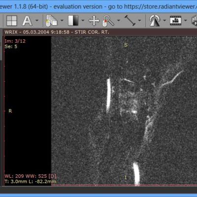 RadiAnt DICOM Viewer 2021,2023,2024 version